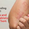 Understanding Fungal Infections and the Best Tablets to Treat Them