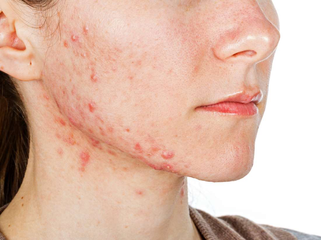 Skar Vanish Kit- Scar Pigmentation Kit (3 Months Pack) - Image 7
