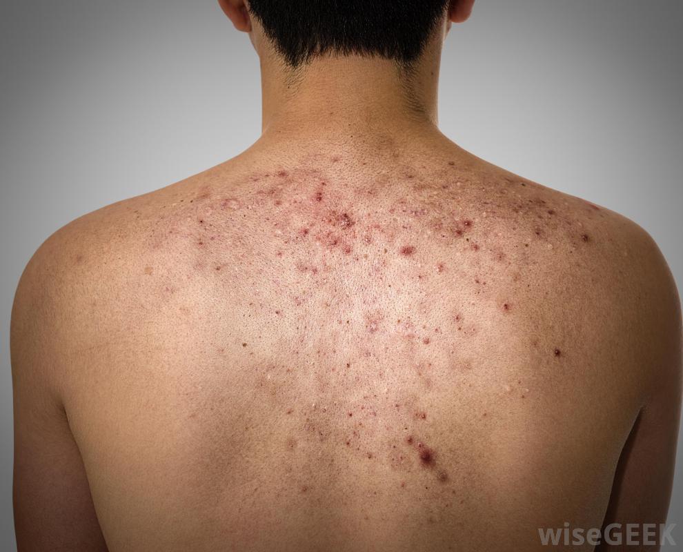 Skar Vanish Kit- Scar Pigmentation Kit (3 Months Pack) - Image 5